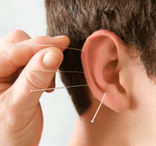 Ein Bild von einem Ohr wärend der Ohr-Akupunktur.